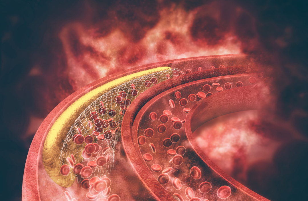 LDL cholesterol symptoms are invisible but can lead to cardiovascular disease.