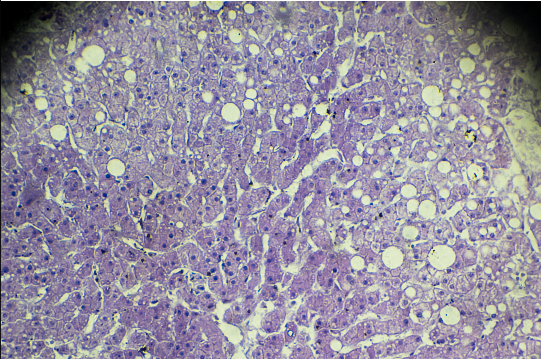 As seen under the microscope, fat on the liver presents itself in obese patients