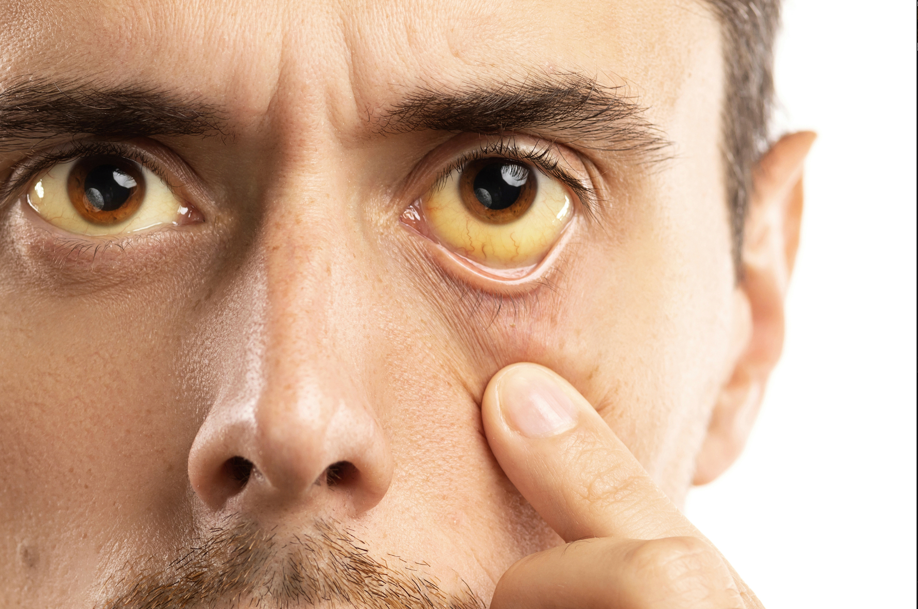 Fatty liver disease can present itself through Jaundice. This symptoms is recognised by its yellow characteristic. 