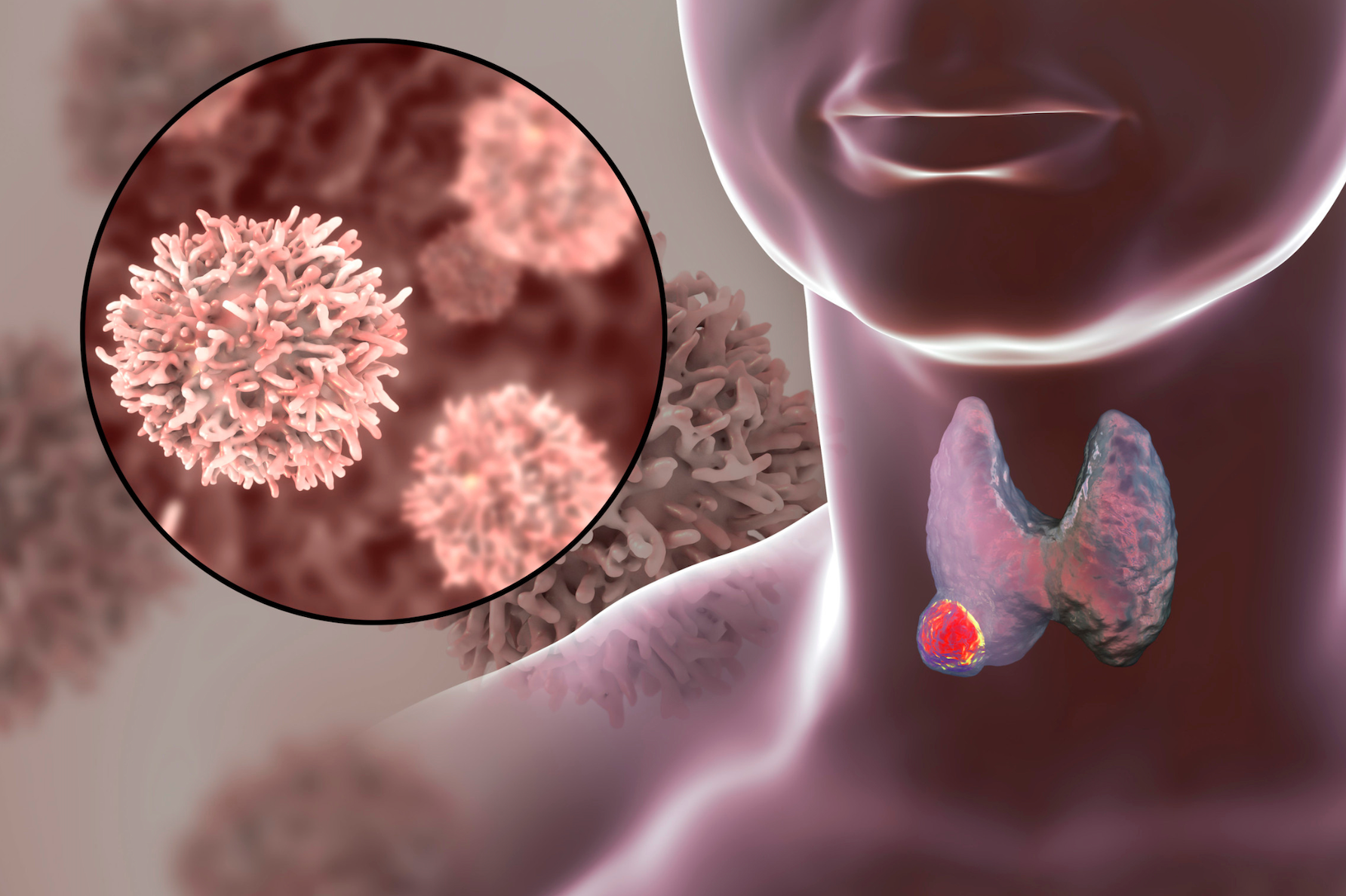 Nodules on this gland are causes by specific diseases and are usually benign. 