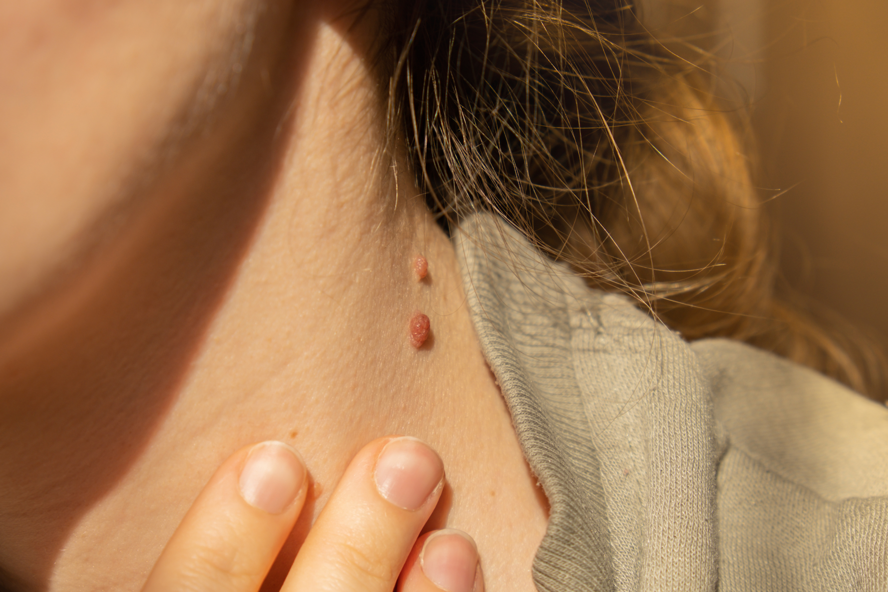Skin cancer is the most common form of cancer and you should always be aware of it. 
